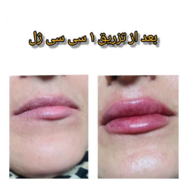 نمونه تزریق 1 سی سی ژل